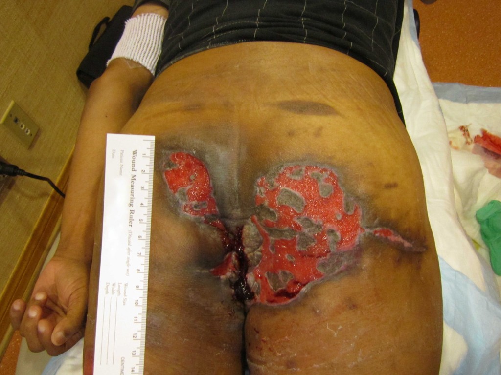 Decubitis Ulcer Before