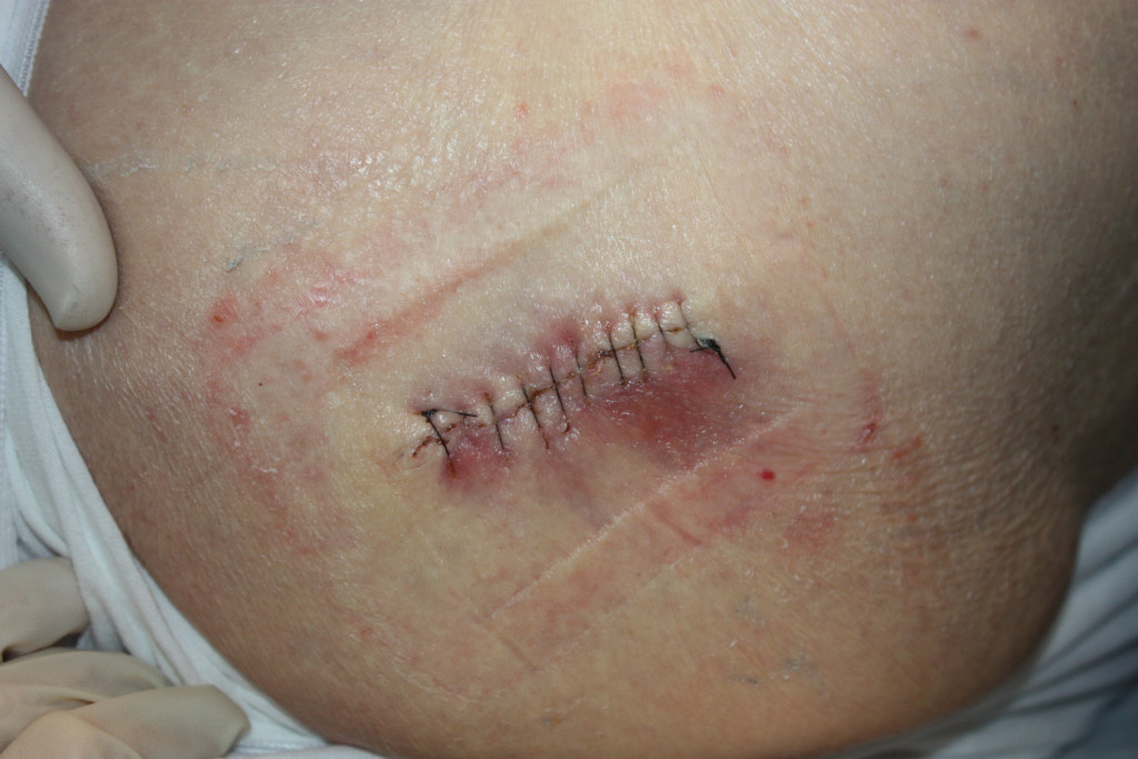 Mass Resection After