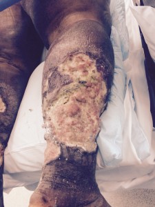 Slough Tissue