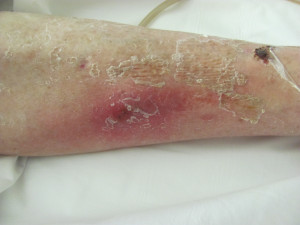 Blanchable Erythema